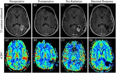  Case report: Radiographic complete response of radiation-induced glioblastoma to front-line radiotherapy: A report and molecular characterization of two unique cases